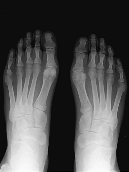 ski-boot-foot-xray